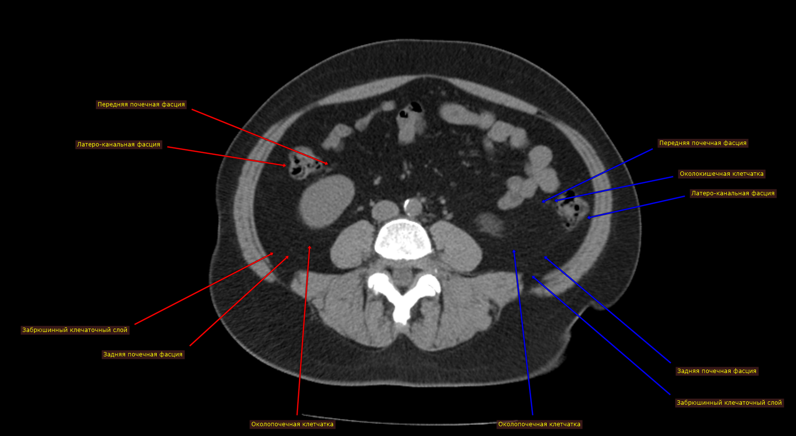 Кт забрюшинной полости с контрастом подготовка. Анатомия забрюшинного пространства на кт. Лейомиосаркома забрюшинного пространства кт. Забрюшинное пространство на кт. Околопочечная клетчатка на кт.