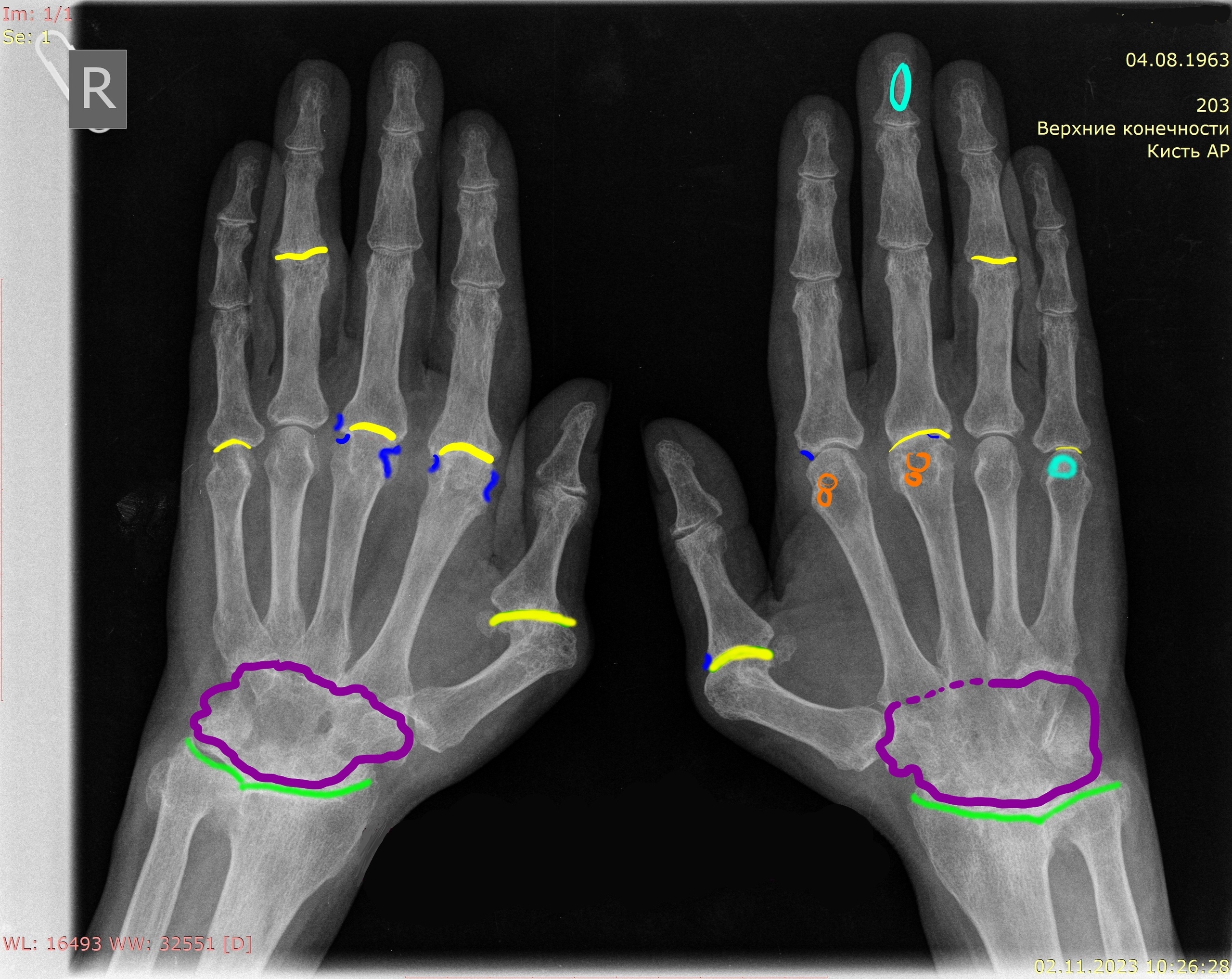 ревматоидный полиартрит. ревматоидный артрит мкб 10. ревматоидный артрит суставов кисти. мутилирующий псориатический артрит. ревмотоиднийполиортрит.