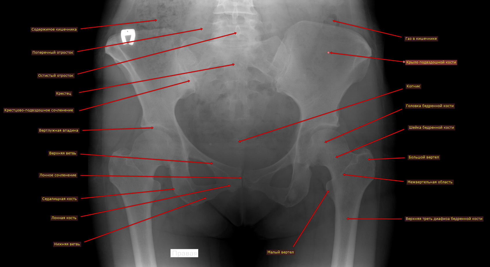 Рентгеноанатомия таза. - Xray Doctor | Boosty
