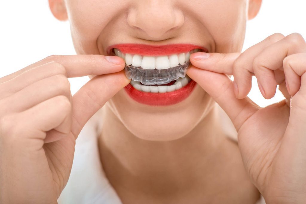 Hiền Niềng Răng Không Mắc Cài